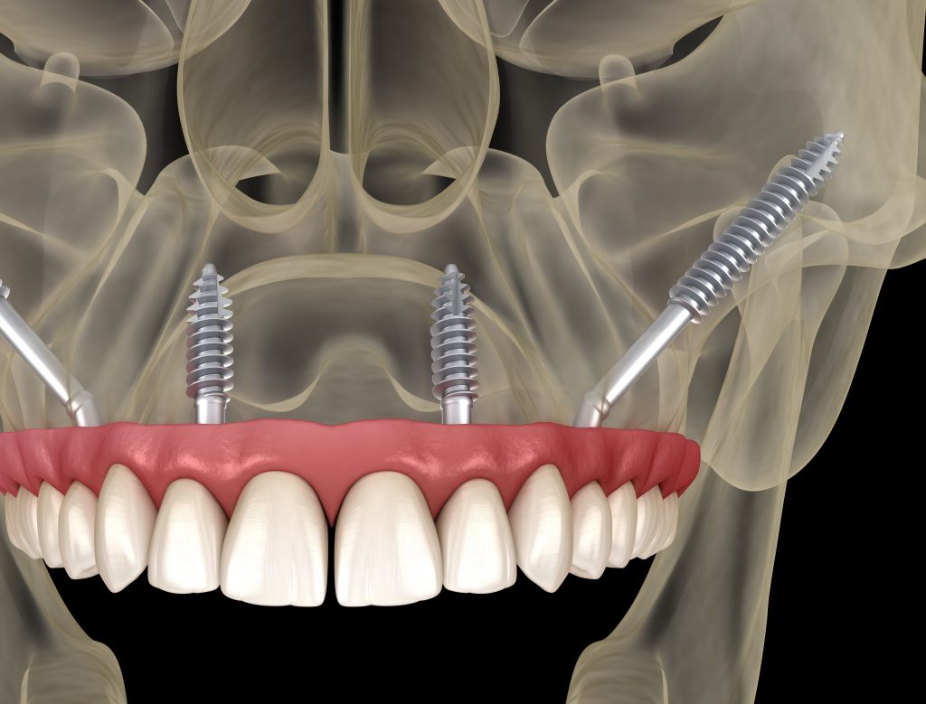 zygomatic implant infographic image